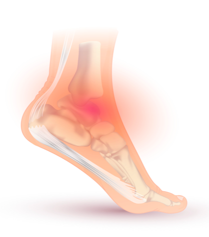 How to Treat an Ankle Sprain with Physiotherapy