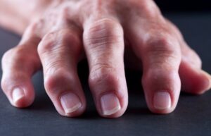 Focus on the Hand and Osteoarthritis