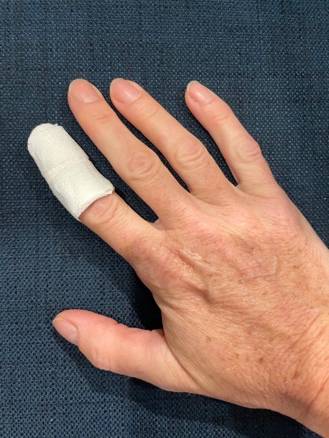 Mallet Finger Injuries