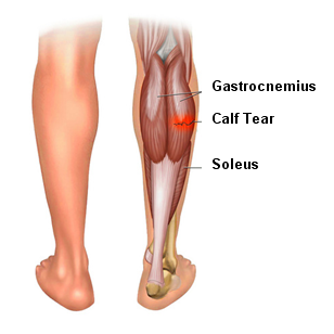 Patient Experience – Calf Tear