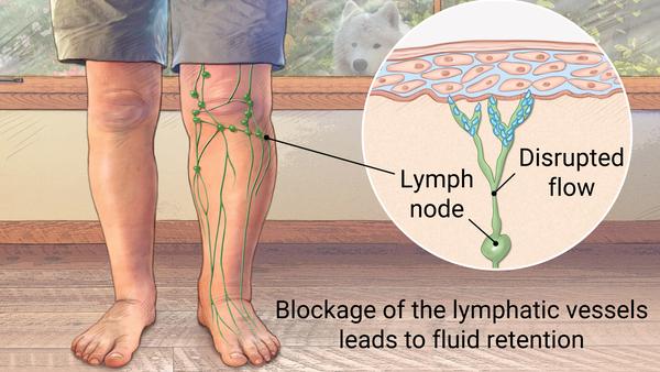 lymphaedema