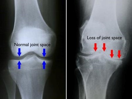 Are You Suffering from Osteoarthritis?