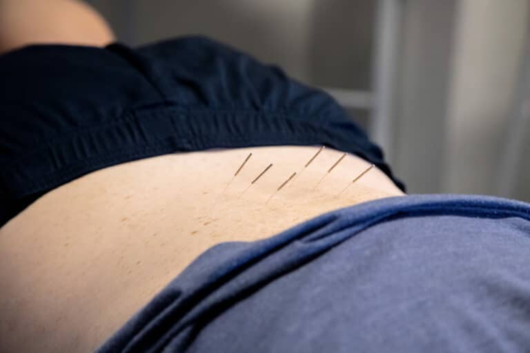 Acupuncture Dry Needling Total Physiotherapy Manly Vale