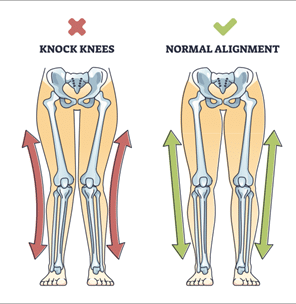 Knock Knees/Normal Alignment