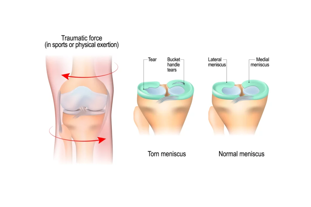 meniscus tear